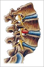 hernia discal. Fuente: http://www.medical-exercise.com/