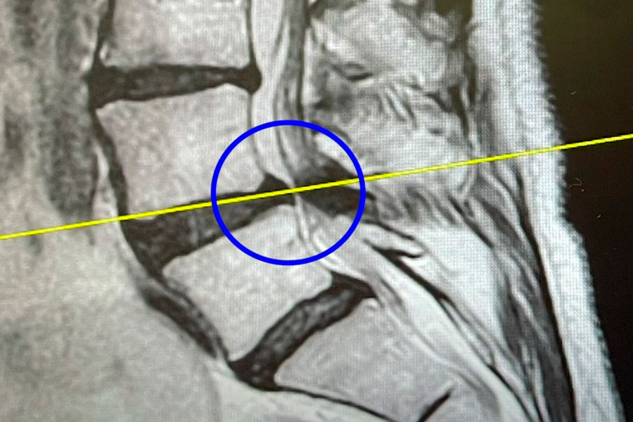 diagnostico-estenosis-canal